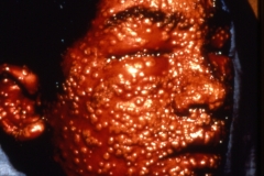 “Classical ordinary smallpox,” confluent type, when the pustules merge into a bubbled mass. Typically fatal.  Photo: WHO.
